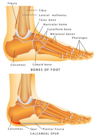 fractured heel bone