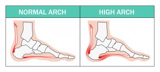 heel arch pain