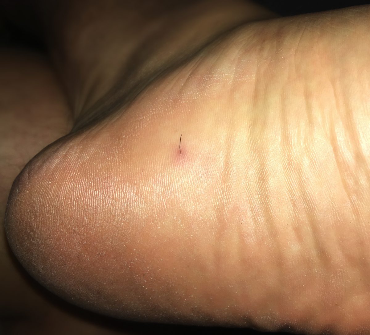 Bearded men and ingrown hairs on the feet Dubai Podiatry Centre