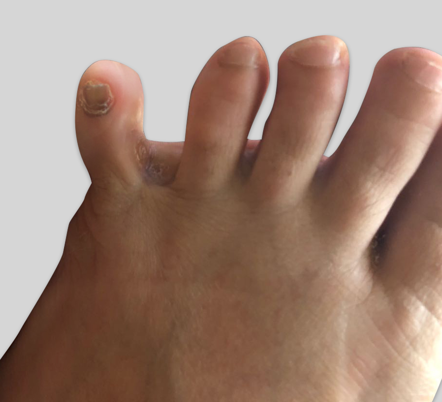 toe corn Dubai Podiatry Centre