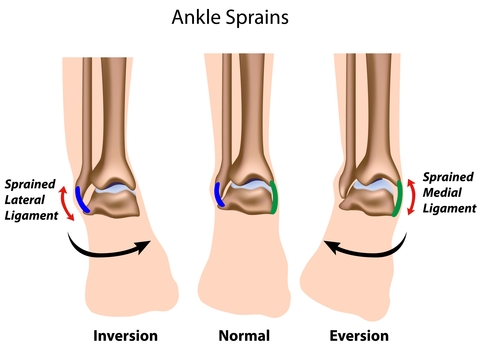Deltoid Ligament Ankle Injuries: Treatment & Diagnosis - Cellaxys