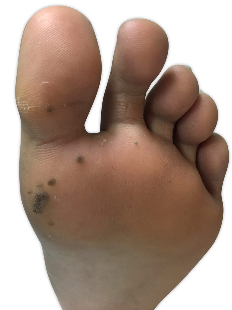 Plantar Warts Dubai Podiatry Centre Dubai Podiatry Centre