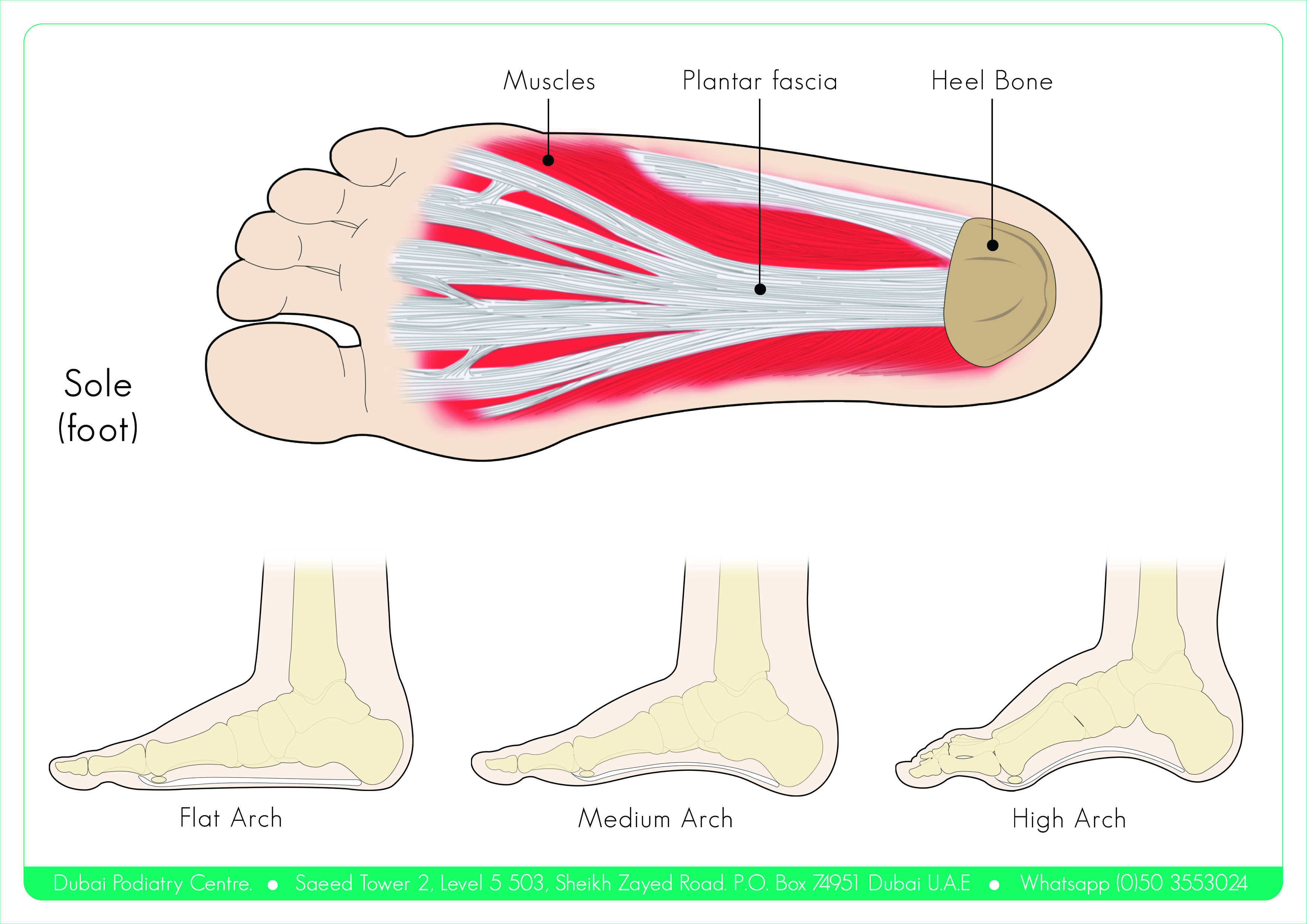 Plantar Fasciitis Cks