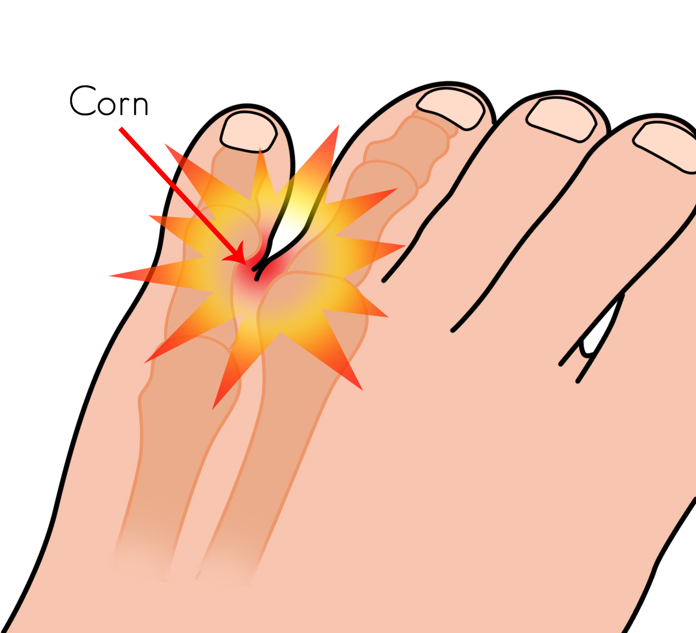 Corn Between The 4th And 5th Toes Dubai Podiatry Centre