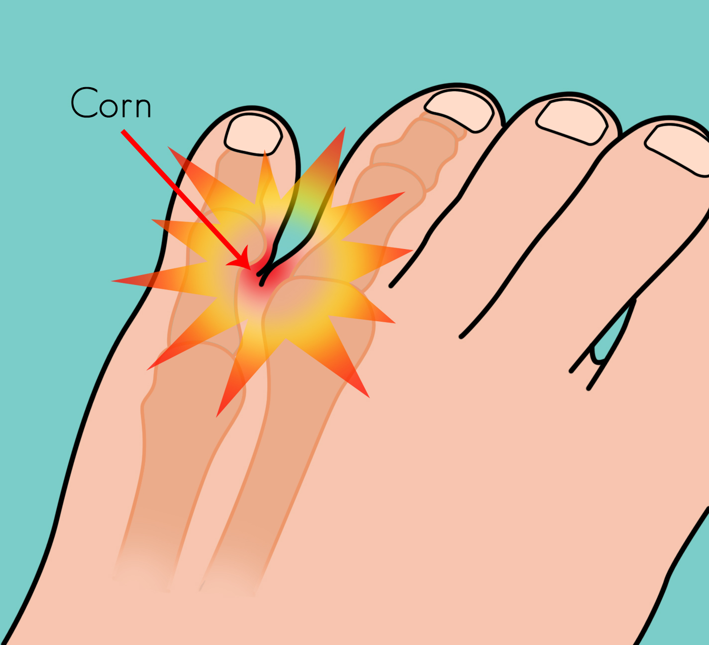4th and 5th toe corn Dubai Podiatry Centre