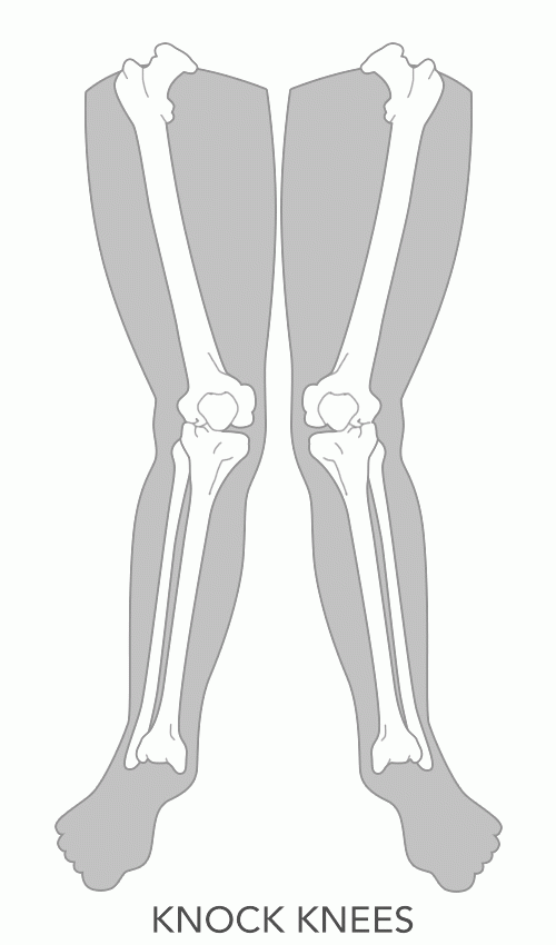 Dubai Podiatry Centre Knock knees Dubai Podiatry Centre