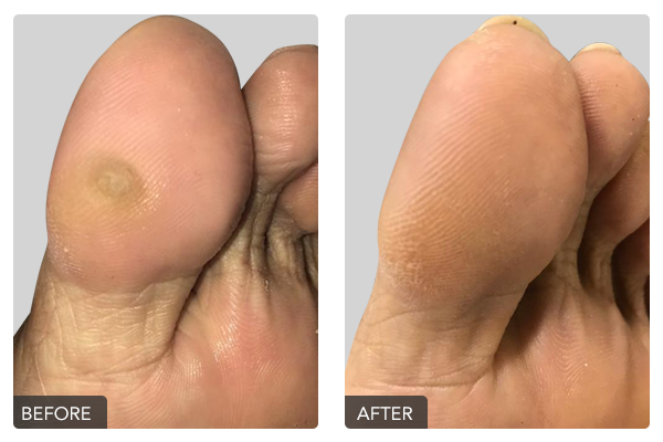 https://dubaipodiatry.com/wp-content/uploads/2019/10/Warts-Before-and-After-1.png