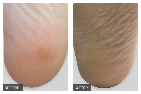 https://dubaipodiatry.com/wp-content/uploads/2019/10/Warts-Before-and-After-4.png