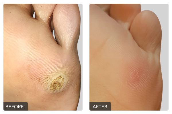 https://dubaipodiatry.com/wp-content/uploads/2019/10/Warts-Before-and-After-7.png