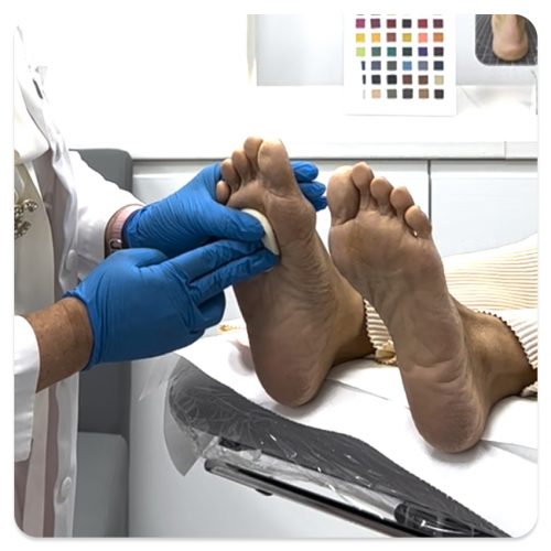 Identify foot corns using Footerella Microscope and use the The