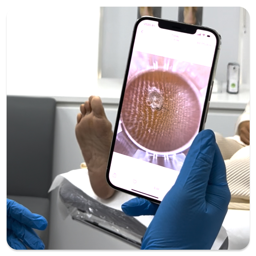 Identify foot corns using Footerella Microscope and use the The Metatarsal Lift and Pull to