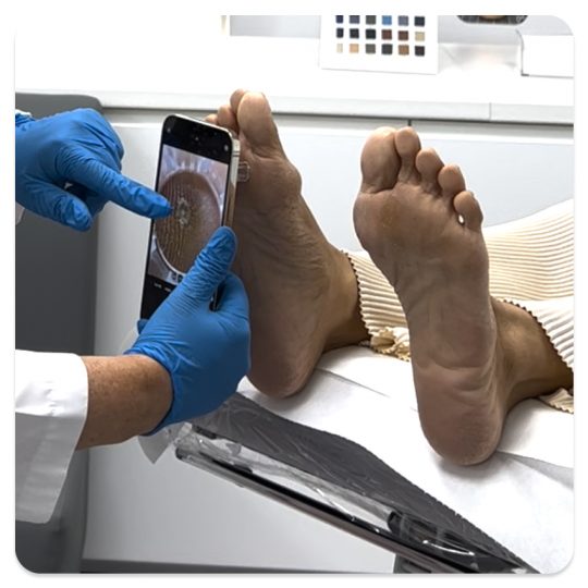 Identify foot corns using Footerella Microscope and use the The Metatarsal Lift and Pull to