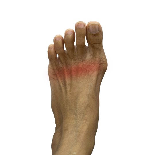 Flat Foot Center_Metatarsalgia Dubai Podiatry Centre