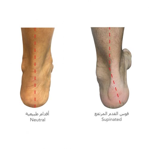 Flat Foot Center_Supination and High Arch Image Dubai Podiatry Centre