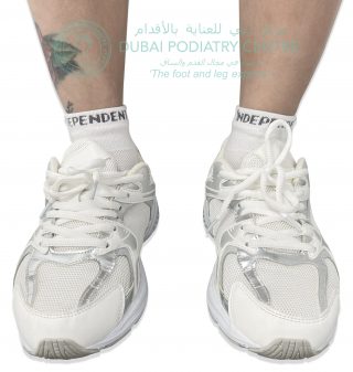 Front view of feet in trainers with uneven shoe tongue position linked to hyperpronation and lower limb alignment issues