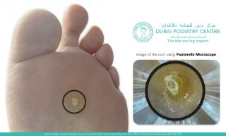 Image showing the bottom of a foot with a small corn circled, alongside a magnified view of the corn under a microscope