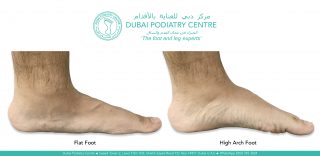 Side-by-side comparison of two feet showing different arch types; the right image labeled “High Arch Foot” displays a pronounced upward curve in the midfoot, with the heel and ball of the foot bearing most of the weight, leaving a visible gap under the arch.