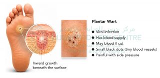 Illustration of a plantar wart on the sole of a foot, showing inward growth beneath the skin and a close-up with small black dots (blood vessels). Text highlights that it is a viral infection, may bleed if cut, and is painful with pressure.