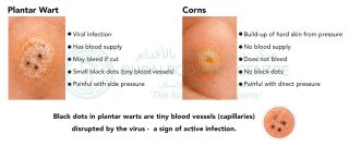 Comparison infographic of a plantar wart and a corn. The plantar wart shows small black dots (blood vessels), is a viral infection with blood supply, may bleed, and is painful with side pressure. The corn is a build-up of hard skin from pressure, has no blood supply, does not bleed, has no black dots, and is painful with direct pressure. A note explains that black dots in plantar warts are tiny blood vessels indicating active infection.