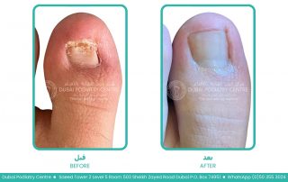 Before treatment of fungal toenail infection showing a damaged big toenail with yellow discoloration, nail thickening, crumbling debris, and signs of onychomycosis.