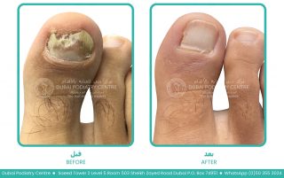 Severe fungal toenail infection before treatment showing thickened, yellow-brown, brittle nail with extensive nail damage and discoloration.