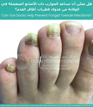 Multiple toes affected by fungal toenail infection (onychomycosis) showing yellow, thickened, and discolored toenails. Clinical image used to discuss whether toe socks can help prevent fungal toenail infections and improve foot hygiene