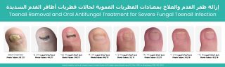 Before-and-after treatment timeline showing recovery from a severe fungal toenail infection. Images document the progress from a thick, discoloured fungal toenail before treatment through toenail removal and oral antifungal therapy, followed by gradual healthy nail regrowth over 12 months. Final photos show a clear, healthy toenail with successful resolution of the infection.
