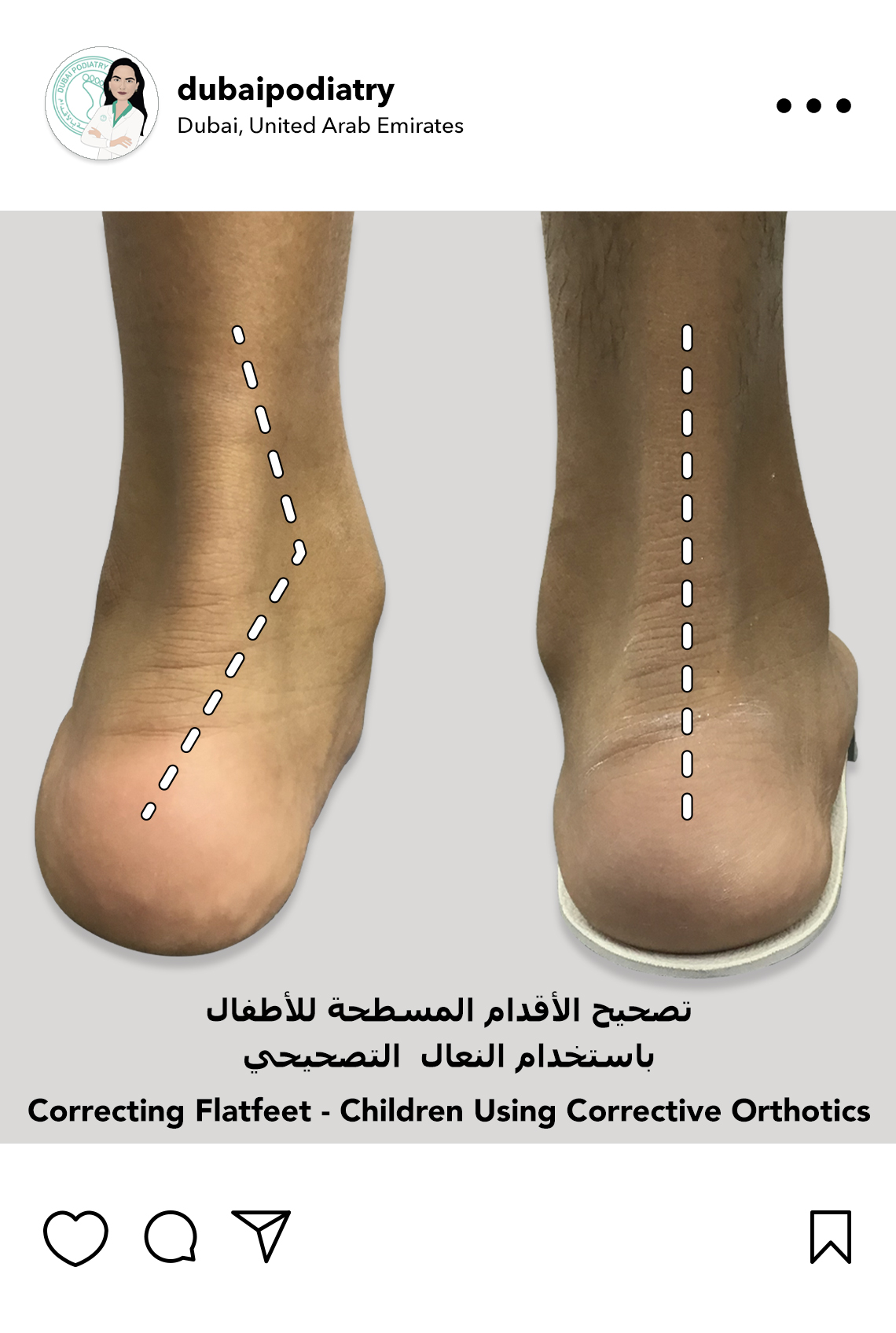 https://dubaipodiatry.com/wp-content/uploads/2026/06/children-flat-feet-correction-custom-orthotics-before-after-dubai-podiatry.jpg