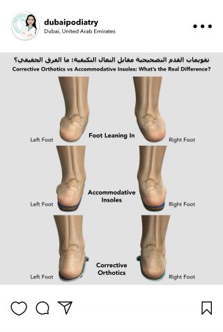 Comparison of foot alignment without support, with accommodative insoles, and with corrective orthotics, demonstrating the effect of orthotic devices on foot posture and heel alignment