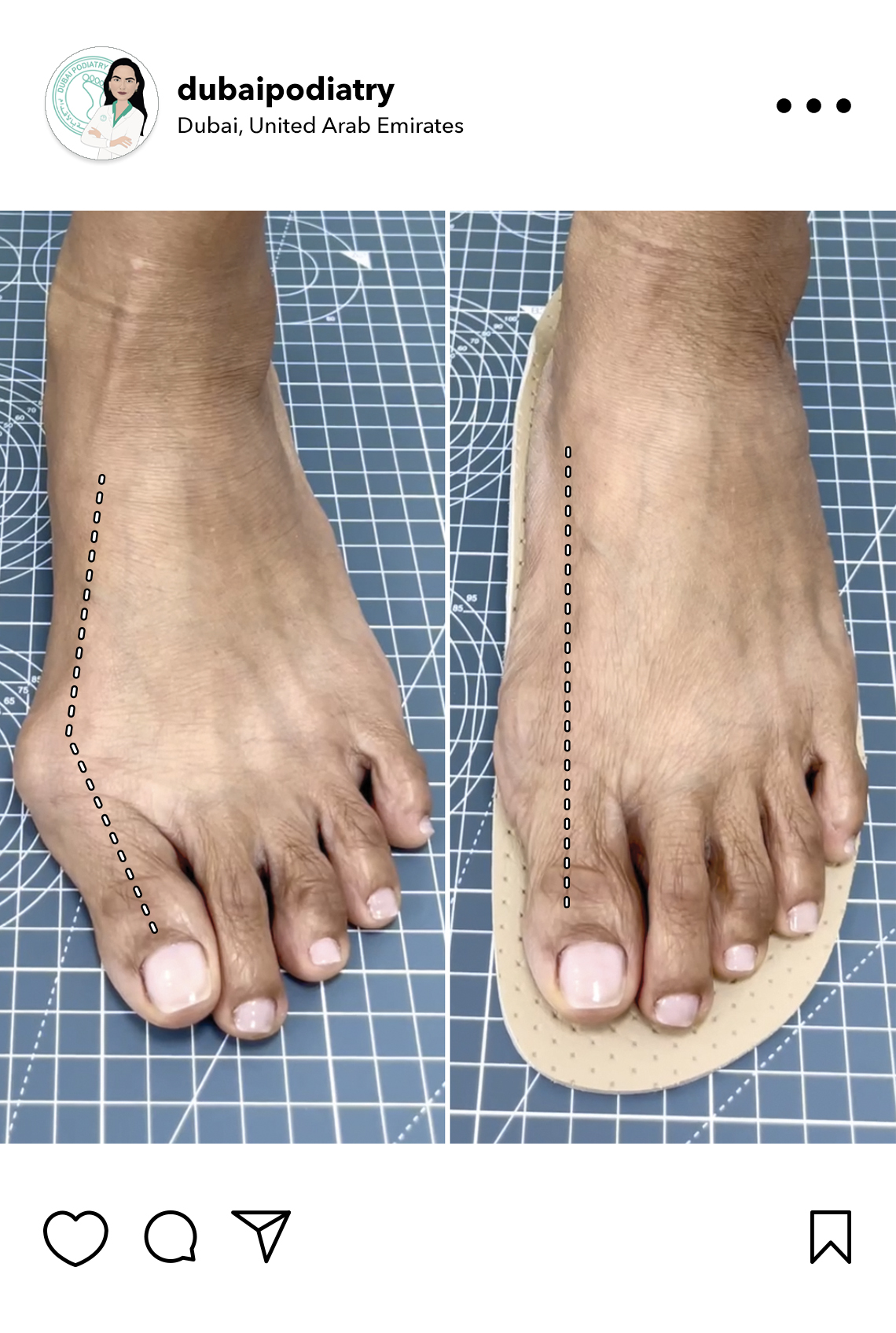 https://dubaipodiatry.com/wp-content/uploads/2026/06/custom-orthotic-correction-foot-alignment-before-after.jpg