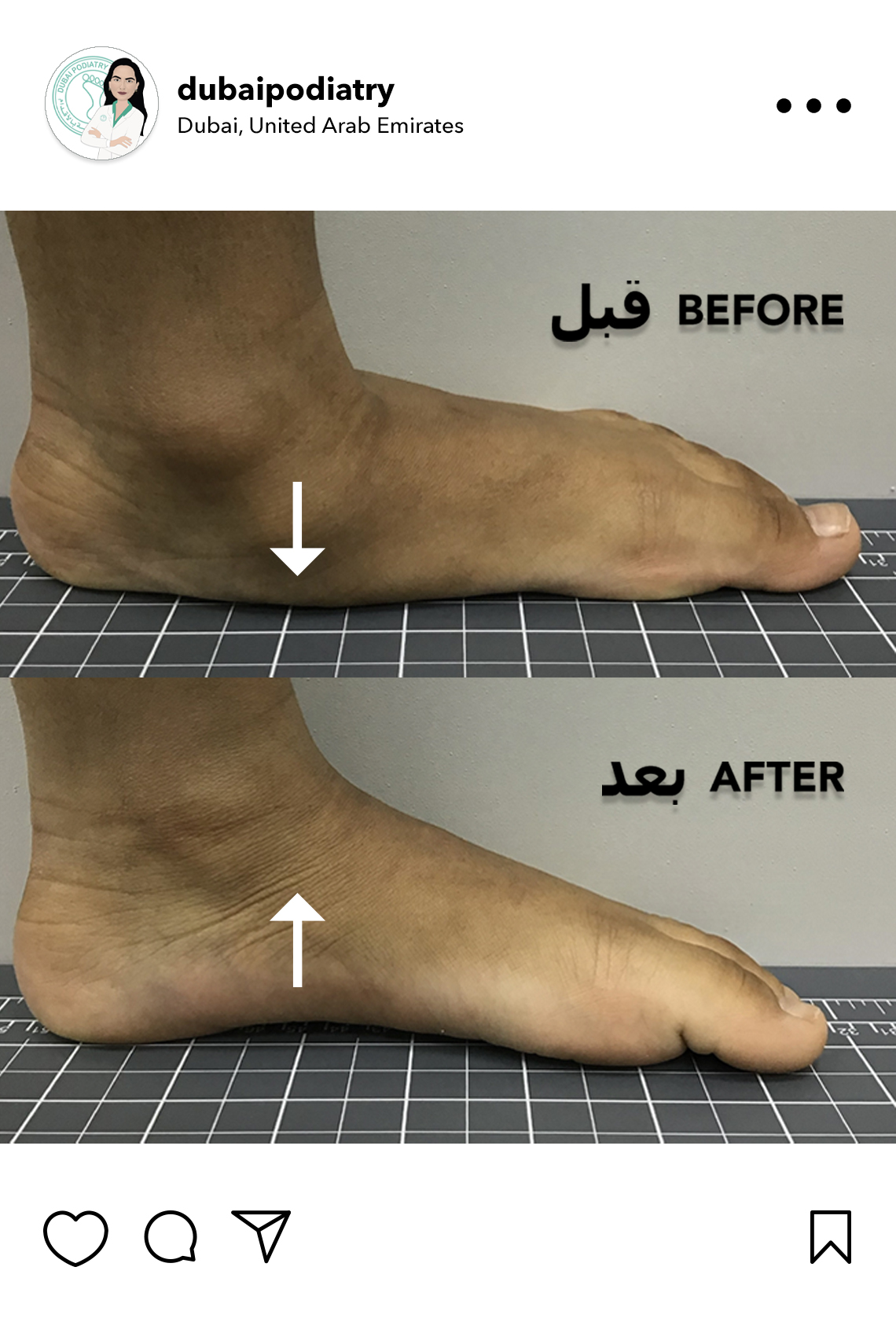 https://dubaipodiatry.com/wp-content/uploads/2026/06/flat-feet-arch-support-before-after-custom-orthotics-dubai-podiatry.jpg