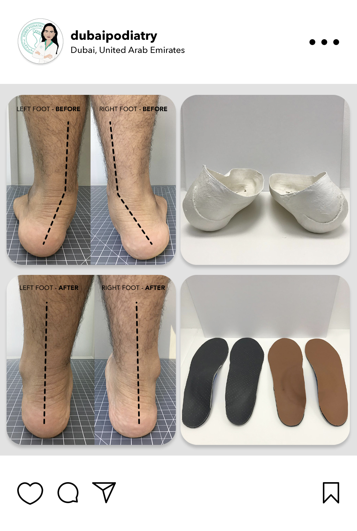https://dubaipodiatry.com/wp-content/uploads/2026/06/flat-feet-before-after-custom-orthotics-foot-casts-dubai-podiatry.jpg