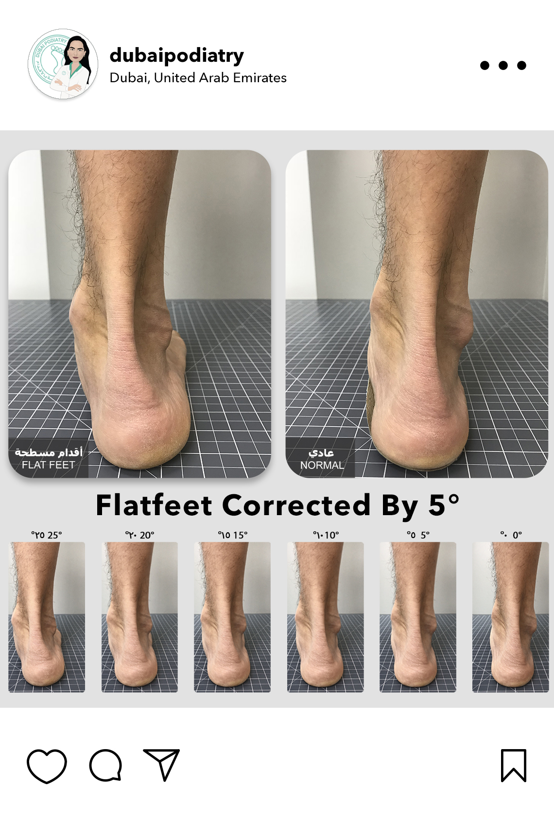 https://dubaipodiatry.com/wp-content/uploads/2026/06/flat-feet-corrected-5-degree-custom-orthotics-dubai-podiatry.jpg