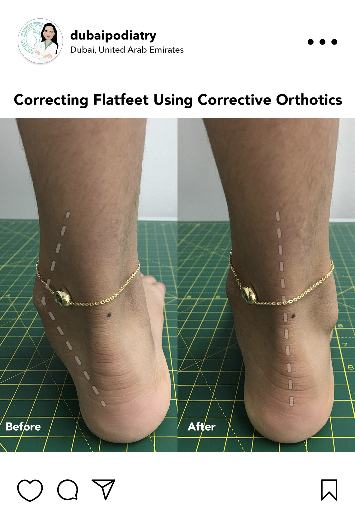 https://dubaipodiatry.com/wp-content/uploads/2026/06/flat-feet-correction-before-after-custom-orthotics-dubai-podiatry.jpg
