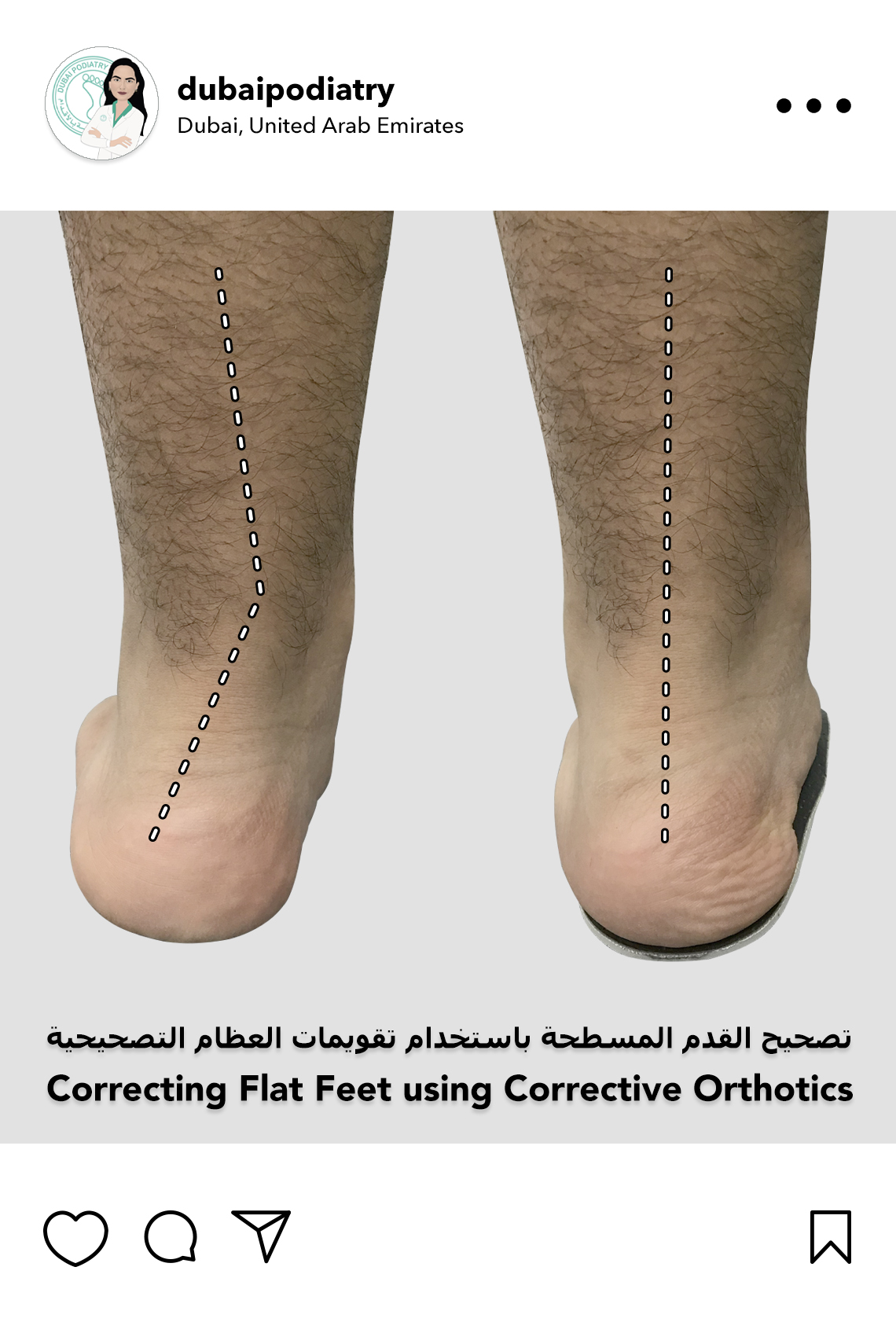 https://dubaipodiatry.com/wp-content/uploads/2026/06/flat-feet-correction-custom-orthotics-before-after.jpg