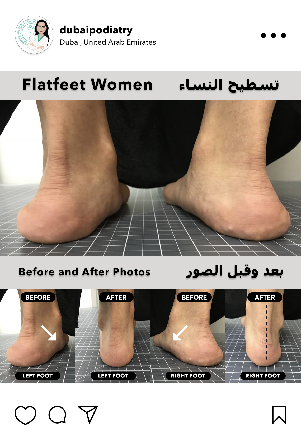 https://dubaipodiatry.com/wp-content/uploads/2026/06/flat-feet-women-before-after-custom-orthotics-dubai-podiatry.jpg