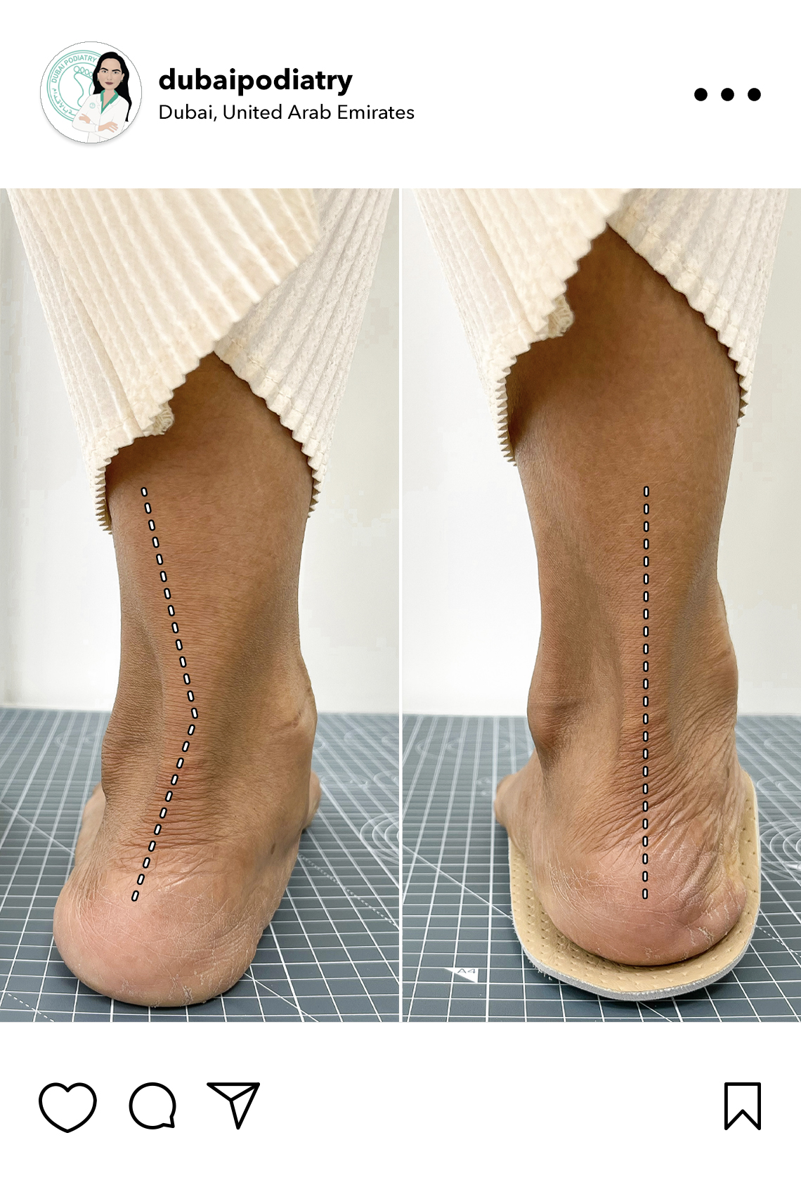 https://dubaipodiatry.com/wp-content/uploads/2026/06/heel-alignment-correction-flat-feet-custom-orthotics-before-after-dubai-podiatry.jpg