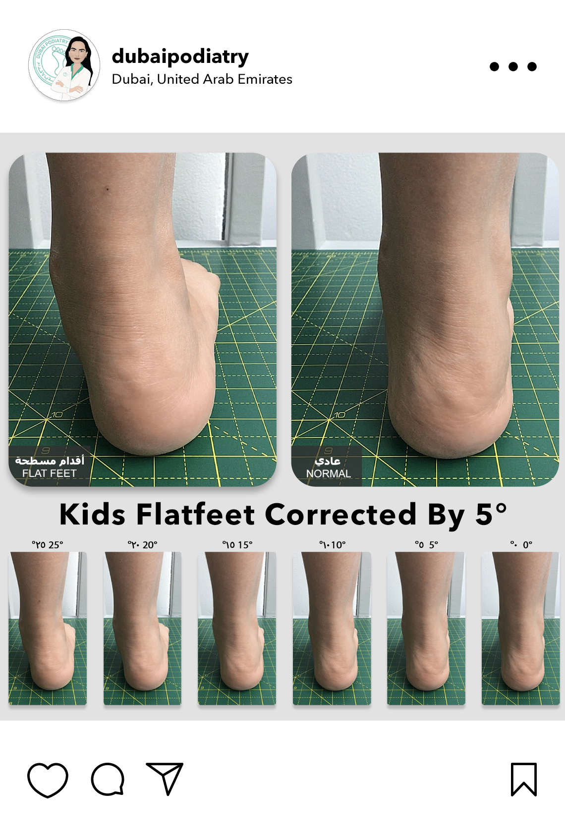 https://dubaipodiatry.com/wp-content/uploads/2026/06/kids-flat-feet-corrected-5-degree-custom-orthotics-dubai-podiatry.jpg