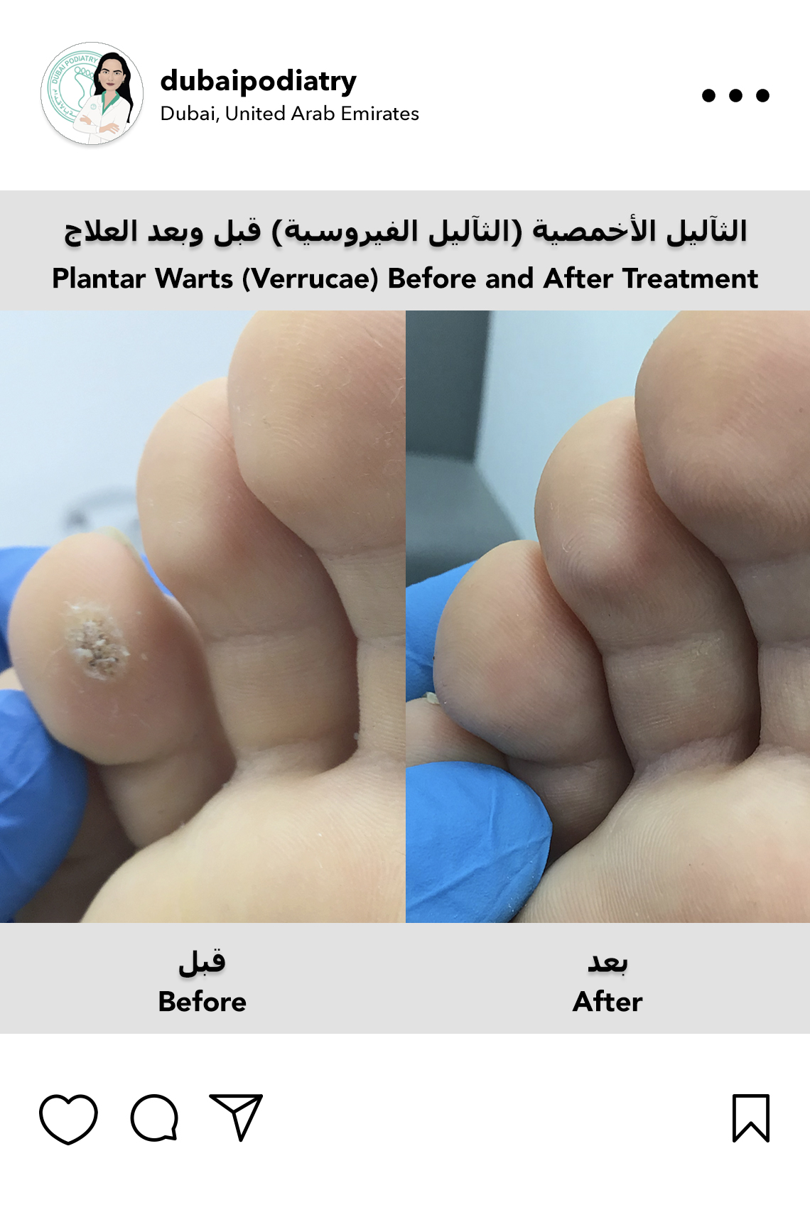 https://dubaipodiatry.com/wp-content/uploads/2026/06/plantar-wart-before-after-treatment-toe-dubai-podiatry.jpg