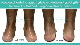 Before and after treatment of adult flat feet using custom corrective orthotics, showing improved heel alignment and foot posture from the rear view at Dubai Podiatry Centre.