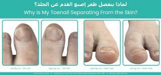 Clinical photographs showing separation of both big toenails from the nail bed (onycholysis), with top and front views illustrating nail detachment caused by repetitive trauma and biomechanical foot abnormalities