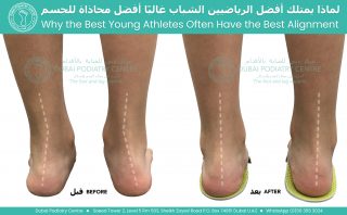 Before and after foot alignment correction in a young athlete showing reduced pronation, improved heel position, and enhanced lower limb biomechanics with corrective orthotics