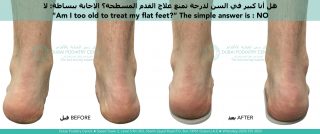 Adult flat feet before and after custom orthotics showing improved heel alignment and foot posture