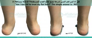 Child with flat feet before and after podiatry treatment using custom orthotics showing corrected heel alignment