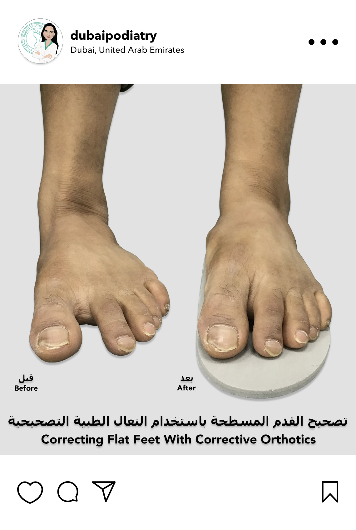 https://dubaipodiatry.com/wp-content/uploads/2026/07/correcting-flat-feet-with-custom-orthotics-before-after.jpg