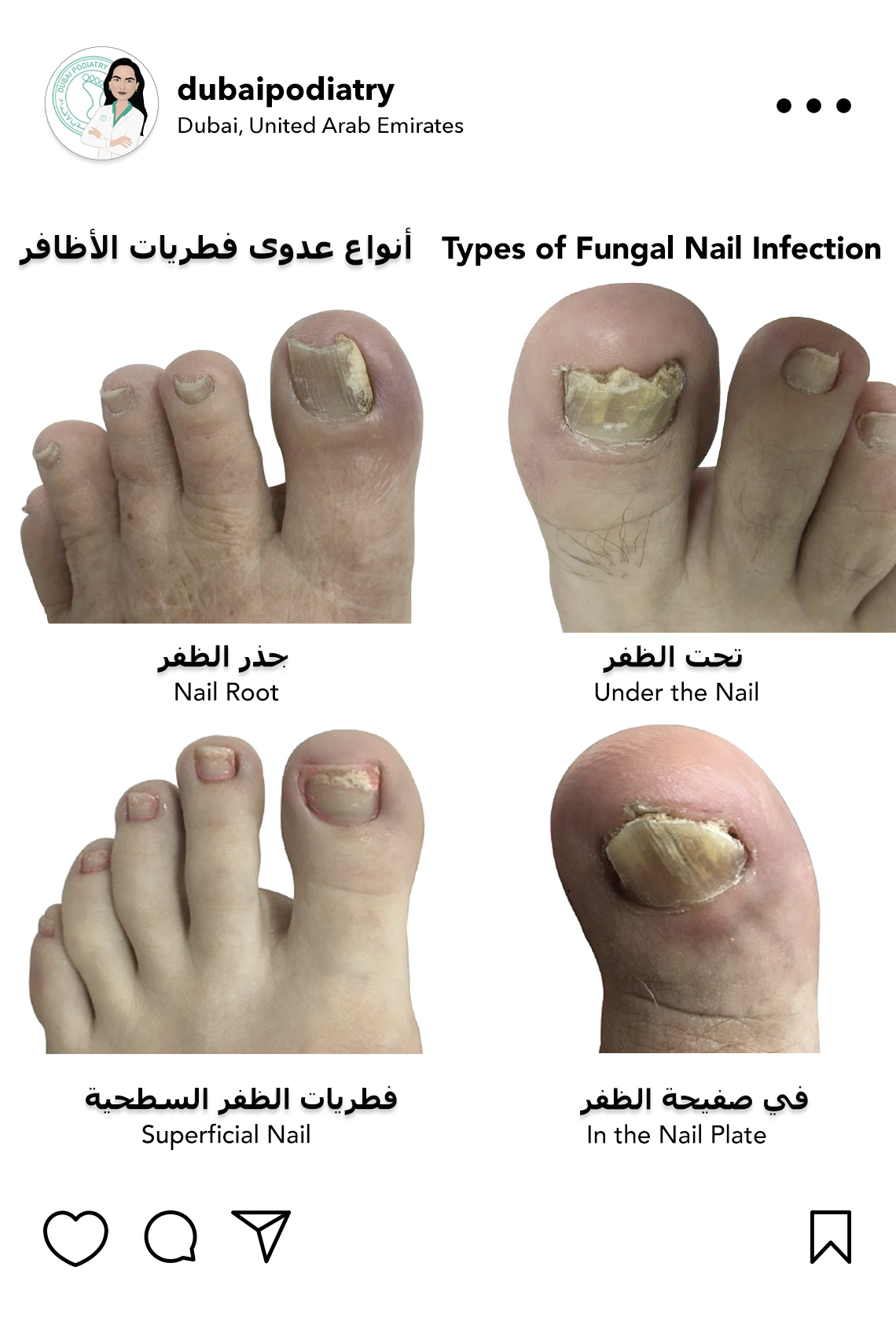 https://dubaipodiatry.com/wp-content/uploads/2026/07/types-of-fungal-nail-infection-toenails.jpg