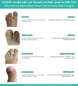 Why home remedies often fail to cure nail fungus showing fungal infections in the nail root, under the nail, superficial nail fungus, and nail plate with appropriate treatment options