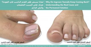 Side and front view of an ingrown toenail demonstrating the curved nail growing into the skin and causing chronic pain. Educational illustration showing why ingrown toenails recur and how permanent treatment can prevent future problems
