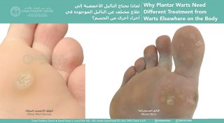 Close-up comparison of a single plantar wart (verruca) and clustered mosaic warts on the soles of the feet