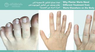 Examples of common warts on the top of the foot, hand and fingers, showing how they differ from plantar warts